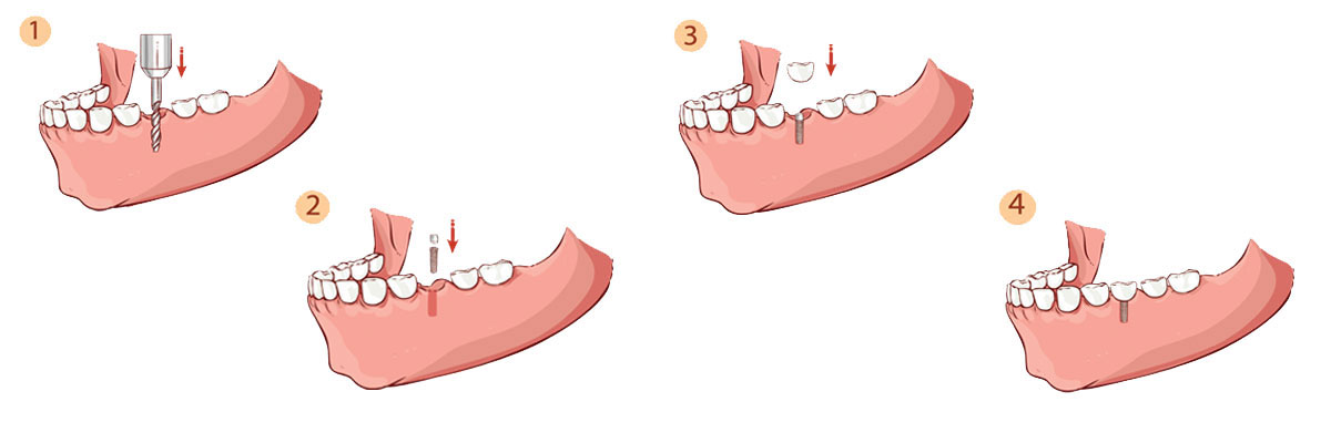 Claremont Dental Implant Restoration