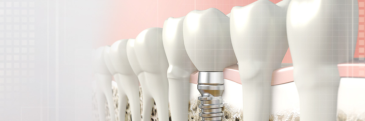Claremont Implant Dentist
